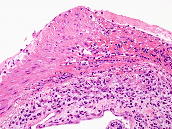 2C6 Aneurysm, mycotic (Case 2) H&E 4