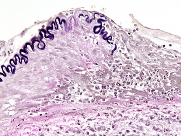 2C7 Aneurysm, mycotic (Case 2) VVG 6