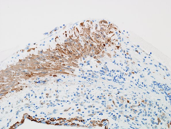 2C8 Aneurysm, mycotic (Case 2) SMA 2