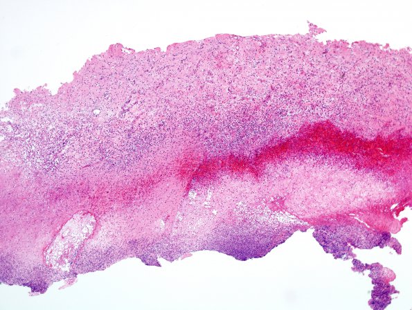 2D1 Aneurysm, mycotic (Case 2) Abscess wall H&E 7