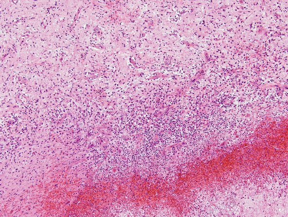 2D2 Aneurysm, mycotic (Case 2) Abscess wall H&E 6