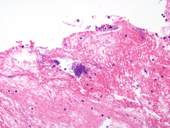 2D3 Aneurysm, mycotic (Case 2) Abscess wall H&E 1