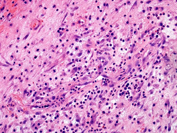 2D4 Aneurysm, mycotic (Case 2) Abscess wall H&E 3