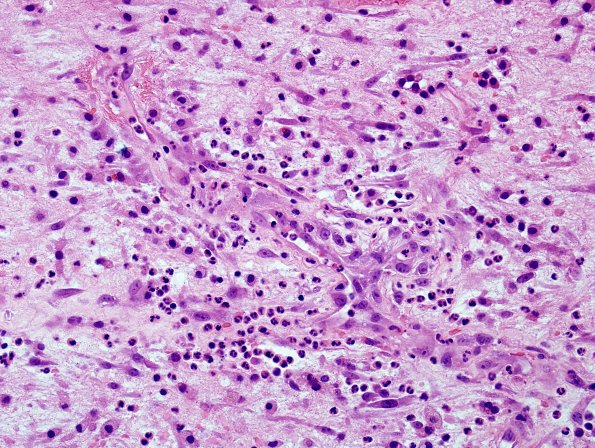 2D5 Aneurysm, mycotic (Case 2) Abscess wall H&E 12