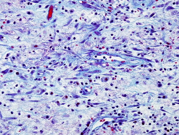 2D6 Aneurysm, mycotic (Case 2) Abscess wall Trichrome 1