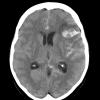 3A1 Mycotic Aneurysm (Case 3) - Copy