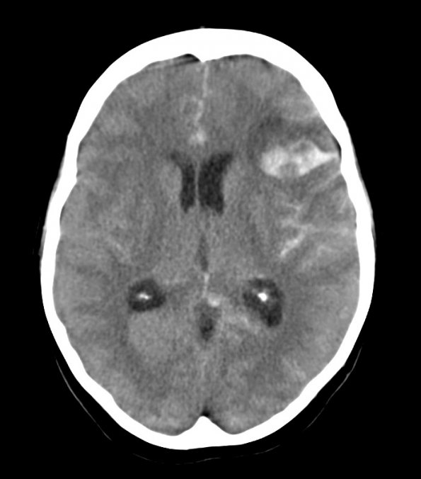 3A1 Mycotic Aneurysm (Case 3) - Copy