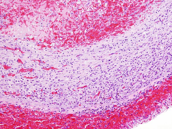 3B Aneurysm, mycotic,Case 3) H&E 1