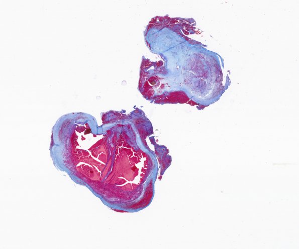 3C Aneurysm, mycotic, Case 3) Trichrome WM