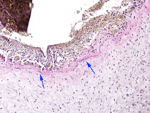 3D Aneurysm,mycotic, Case 3) VVG 2 copy