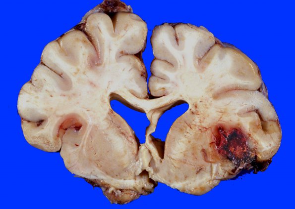 4A1 Aneurysm, mycotic (Case 4) gross 1