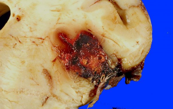 4A2 Aneurysm, mycotic (Case 4) gross 2