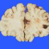 4A3 Aneurysm, mycotic (Case 4) gross 3