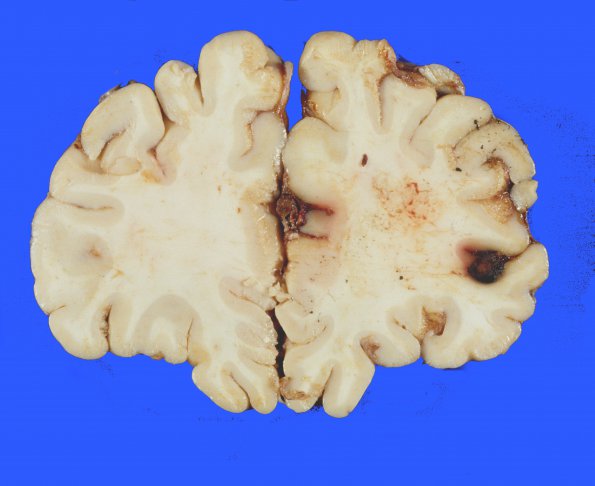 4A3 Aneurysm, mycotic (Case 4) gross 3