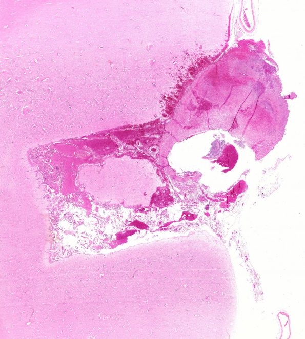 4B1 Aneurysm, mycotic (Case 4) WM