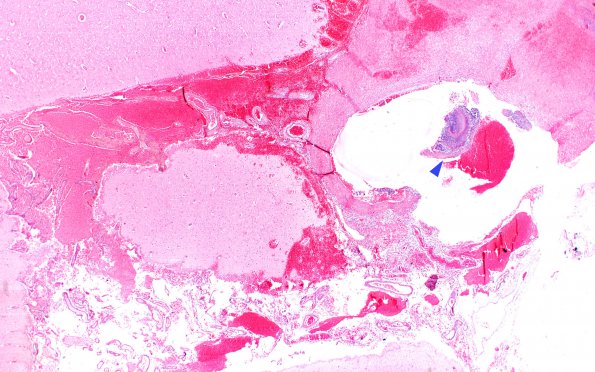 4B2 Aneurysm, mycotic (Case 4) 2X copy