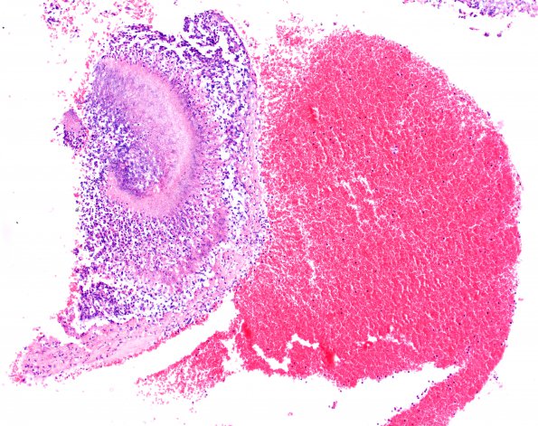 4B3 Aneurysm, mycotic (Case 4) 20X