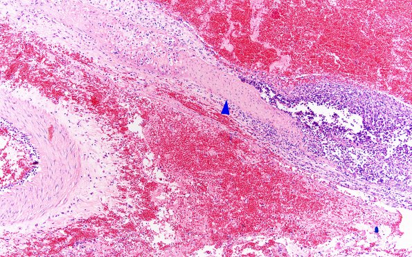 4B6 Aneurysm, mycotic (Case 4) copy