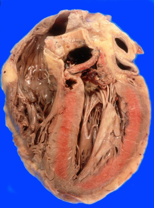 5A1 Aneurysm, mycotic (Case 5), ruptured 5