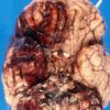 5B1 Aneurysm, mycotic (Case 5), ruptured 4