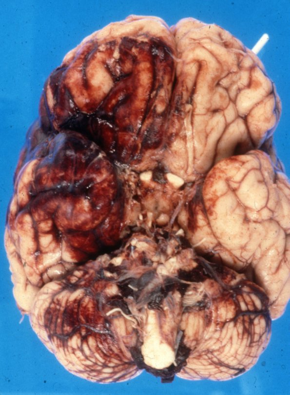 5B1 Aneurysm, mycotic (Case 5), ruptured 4