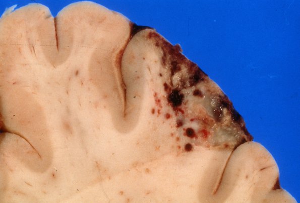 5B2 Aneurysm, mycotic (Case 5), ruptured 2