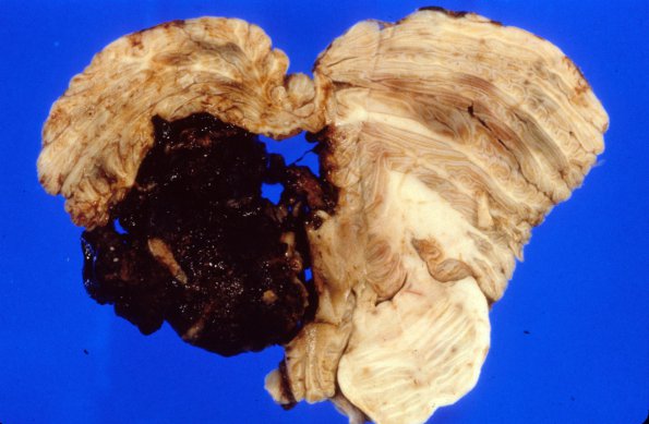 5B3 Aneurysm, mycotic (Case 5), ruptured 1