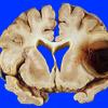 6A1 Aneurysm (Case 6) mycotic gross 1