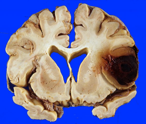 6A1 Aneurysm (Case 6) mycotic gross 1