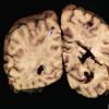 7A1 Meningitis, mycotic aneurysm (Case 7) Gross _8 copy