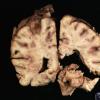 7A2 Meningitis, mycotic aneurysm (Case 7) Gross _7