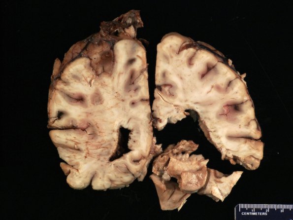 7A2 Meningitis, mycotic aneurysm (Case 7) Gross _7