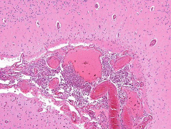 7B3 Meningitis, mycotic aneurysm (Case 7) H&E 