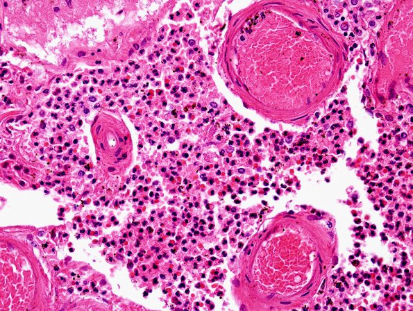  7B4 Meningitis, mycotic aneurysm (Case 7) H&E 7