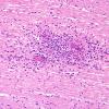 7B5 Meningitis, mycotic aneurysm (Case 7) H&E 1