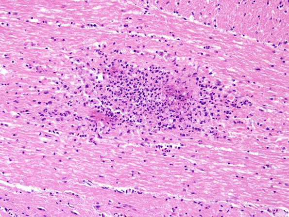 7B5 Meningitis, mycotic aneurysm (Case 7) H&E 1