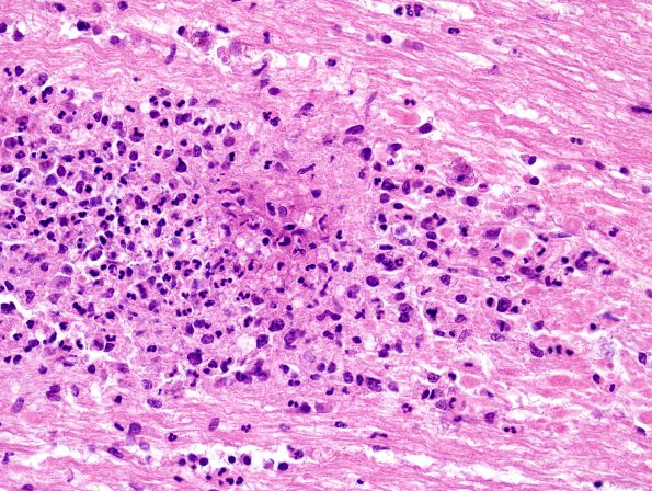 7B6 Meningitis, mycotic aneurysm (Case 7) H&E 1A