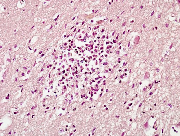 7C1 Meningitis, mycotic aneurysm (Case 7) Gram 1