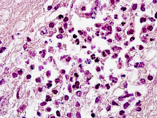 7C2 Meningitis, mycotic aneurysm (Case 7) Gram 4