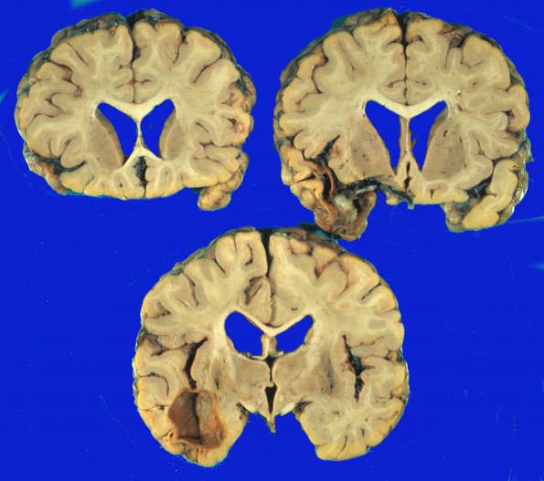 10A1 Aneurysm (Case 10) gross 2