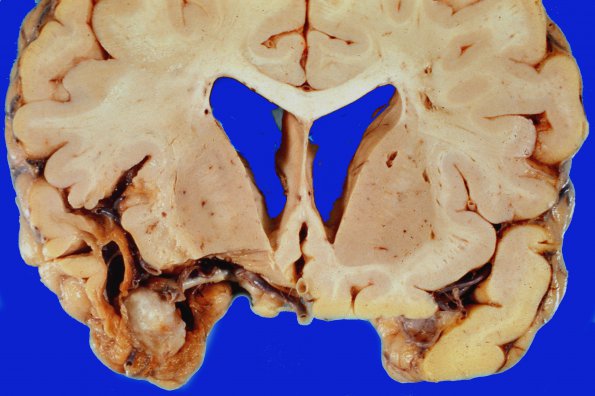 10A2 Aneurysm (Case 10) gross 1