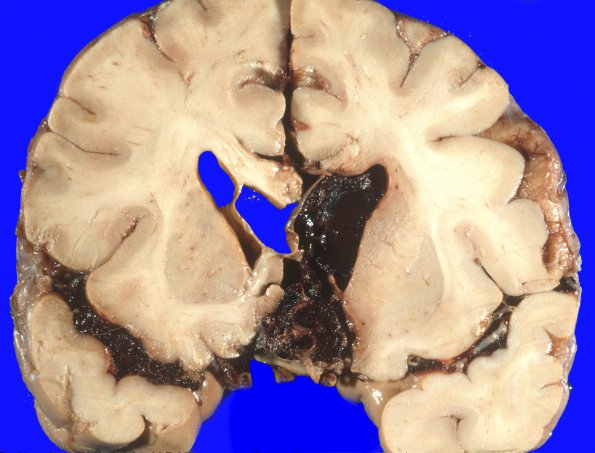 11A2 Aneurysm, ACA (Case 11) 1