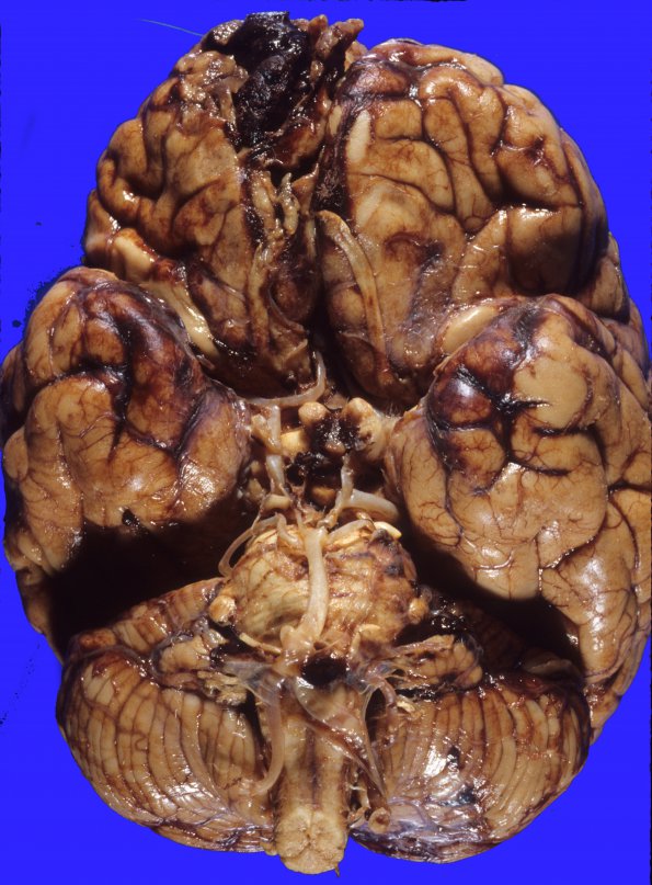 12A1 Aneurysm, saccular, ACA (Case 12) 7