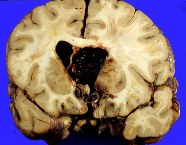 12A2 Aneurysm, saccular, ACA (Case 12)  1