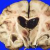 12A6 Aneurysm, saccular, ACA (Case 12) 7 (2) copy