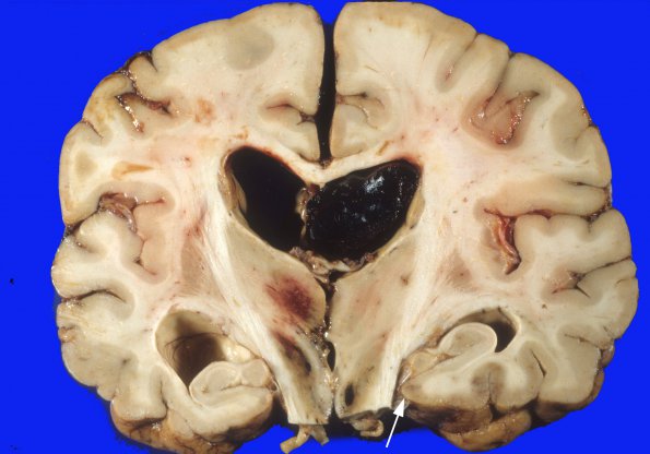 12A6 Aneurysm, saccular, ACA (Case 12) 7 (2) copy