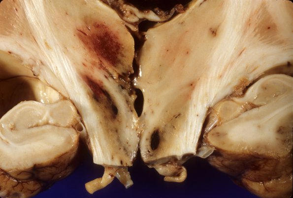 12A7 Aneurysm, saccular, ACA (Case 12) 5