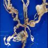 13A1 Aneurysm (Case 13) 3