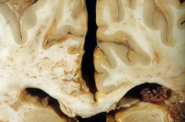 13A5 Infarct, sp ACA aneurysm rupture with laminar appearance (Case 13)