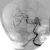 15A1 Aneurysm, coiled, infarct, subacute (Case 15) Angiogram 3 - Copy